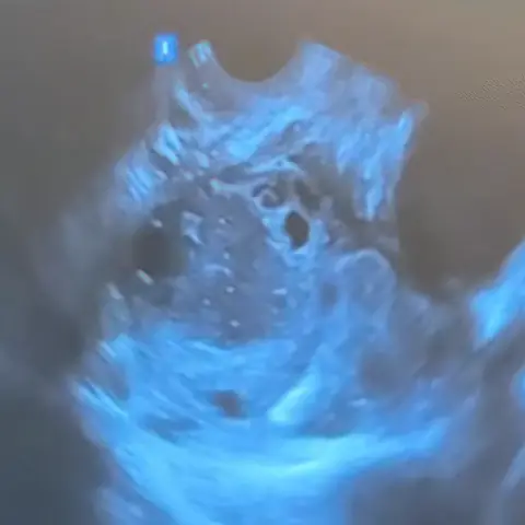 시술 전 5cm 자궁내막종