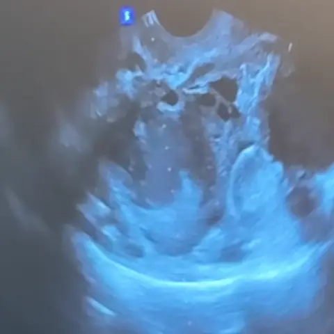 낭종 흡입 시술 과정